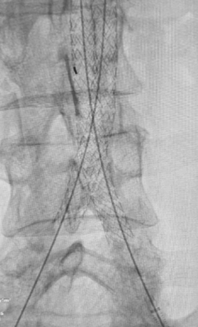 Imagen angiográfica educativa de una reconstrucción endovascular aortoilíaca