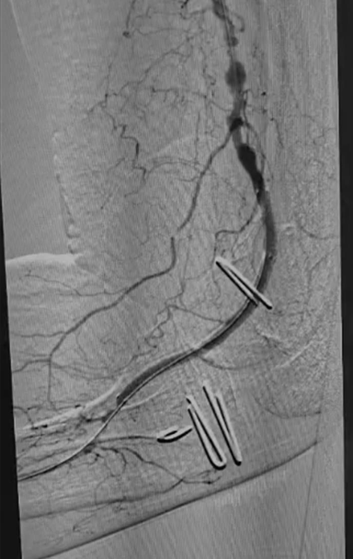 Imagen angiográfica educativa tras tratamiento endovascular con endoprótesis